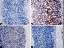 Bax staining in immunohistochemically stained gastric tissues